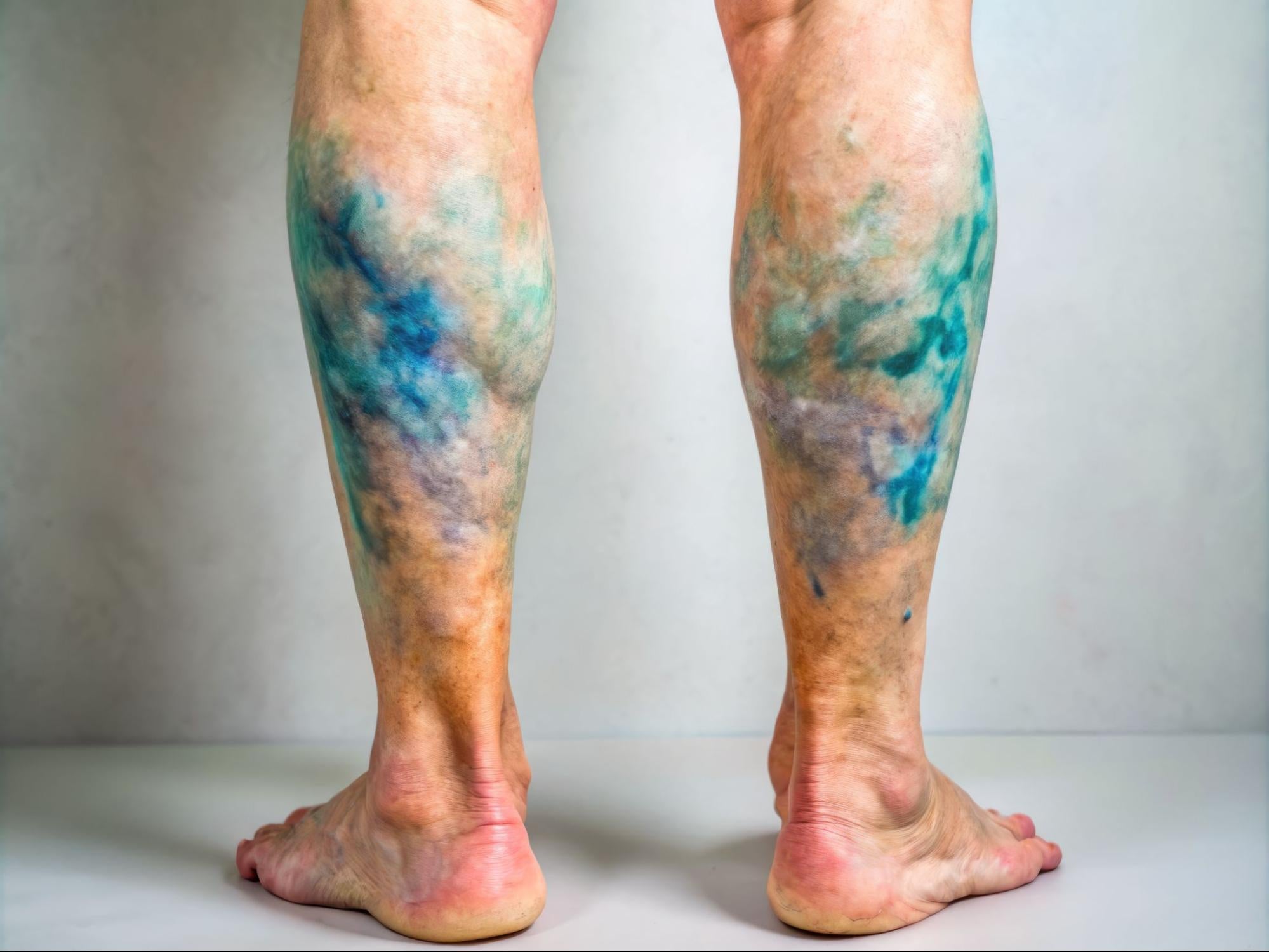 How Diabetes Causes Poor Circulation to the Lower Extremities